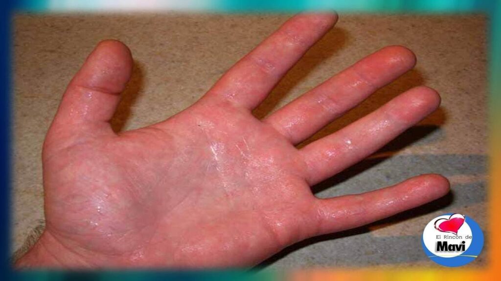 Cuando el estrés nos supera: El vínculo entre la migraña y la sudoración excesiva desde la psicología 1 cuando el estres nos supera el v