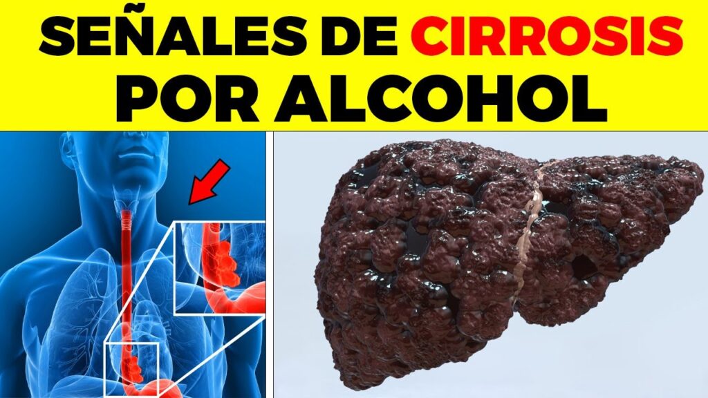 El alcohol como posible alivio de las mioclonias: una mirada desde la psicología 1 el alcohol como posible alivio d