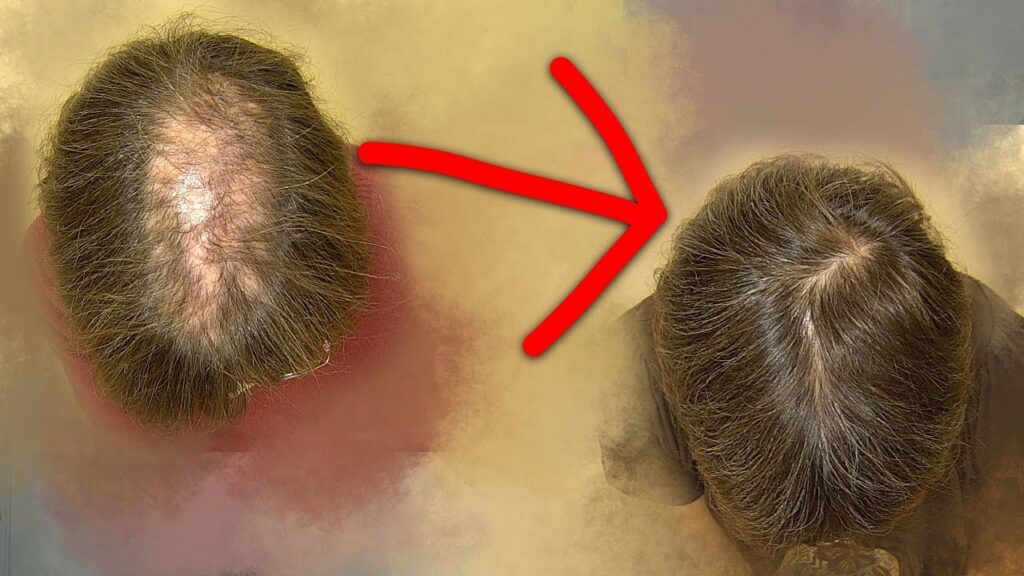 El enlace entre el estrés y la caída del cabello en hombres: Una mirada desde la psicología 1 el enlace entre el estres y la c