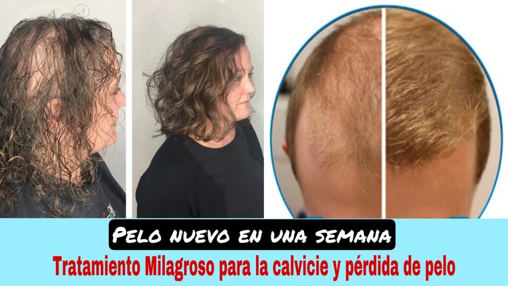 El estrés, el gran enemigo de tu cabello: Descubre por qué se cae y cómo prevenirlo. 1 el estres el gran enemigo de tu