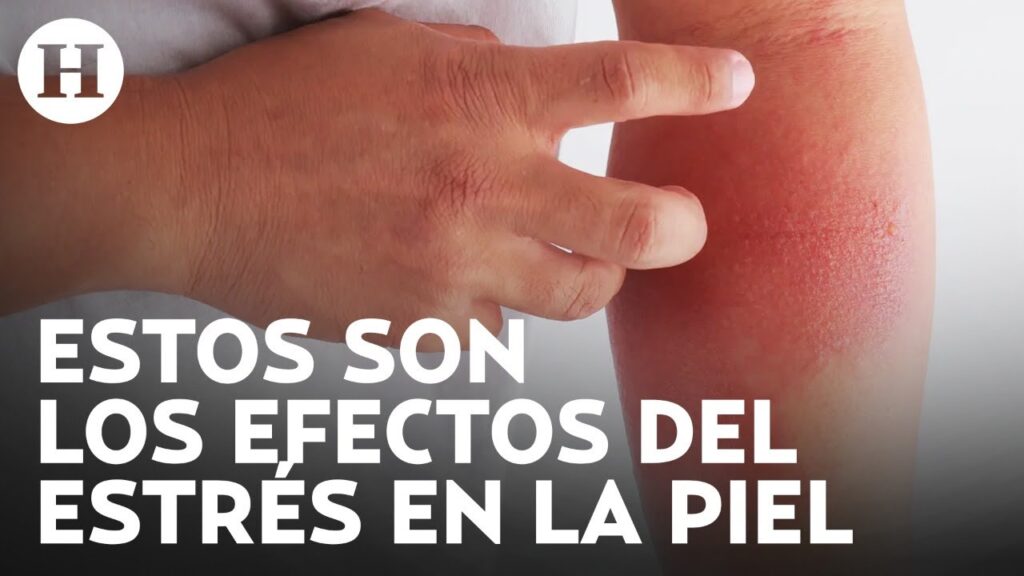 El estrés y su impacto en la piel: Descubre por qué sientes picor en tu rostro 1 el estres y su impacto en la pie