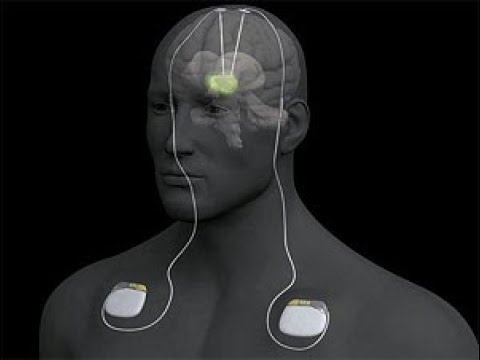 El impacto de las mioclonías en el tratamiento con levodopa: consideraciones desde la perspectiva psicológica 1 el impacto de las mioclonias en 2