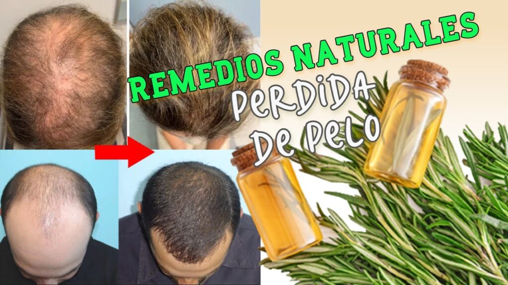 El impacto del estrés en la caída del cabello: cómo manejarlo desde la perspectiva psicológica 1 el impacto del estres en la caid