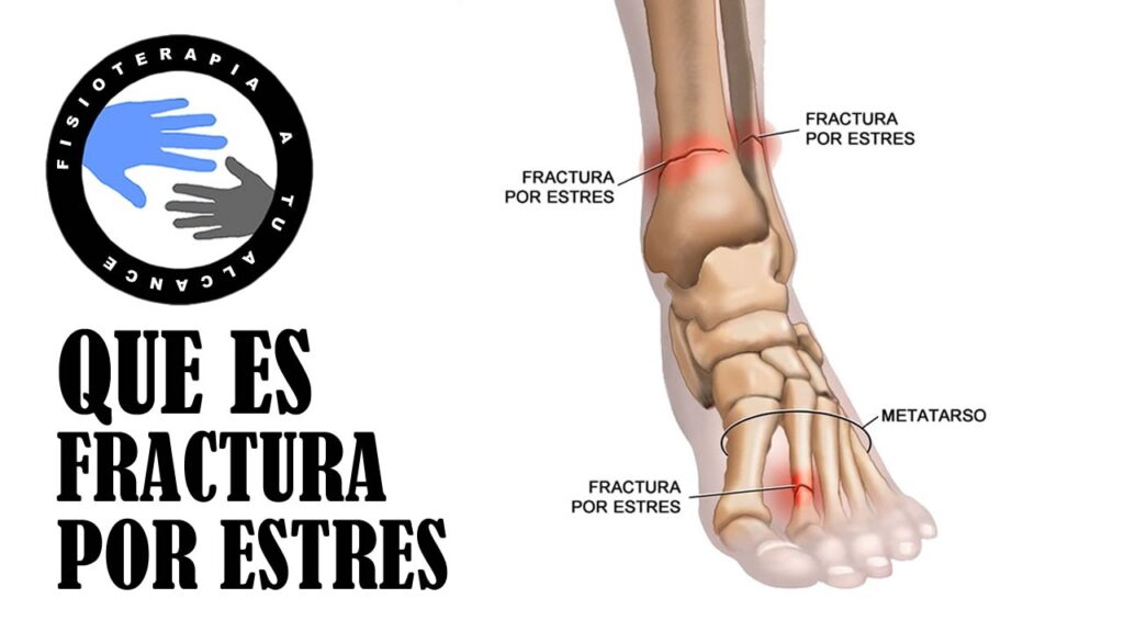 El Impacto Psicológico de las Fracturas por Estrés en el Pie: Causas y Consecuencias Emocionales 1 el impacto psicologico de las fr