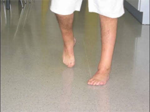 El impacto psicológico del ictus: cómo enfrentar el dolor de cabeza y sus consecuencias emocionales 1 el impacto psicologico del ictus