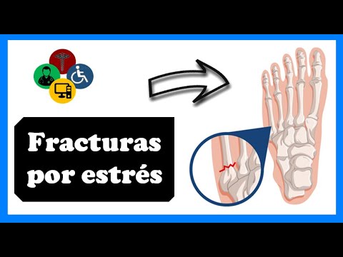 Fractura por estrés en el calcáneo: causas y factores de riesgo 1 fractura por estres en el calcan