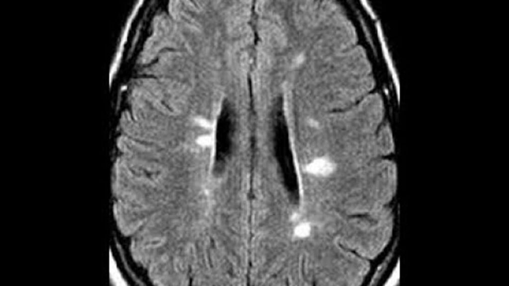 La compleja relación entre la esclerosis múltiple y los trastornos de ansiedad: una mirada desde la psicología. 1 la compleja relacion entre la es