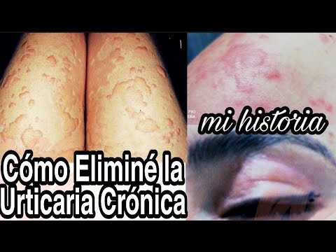 La conexión entre la ansiedad y el picor en la piel: explorando su vínculo desde la psicología 1 la conexion entre la ansiedad y 118