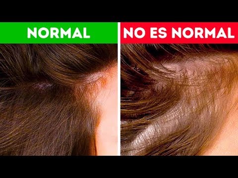 La duración de la pérdida de cabello relacionada con el estrés desde la perspectiva psicológica 1 la duracion de la perdida de cab