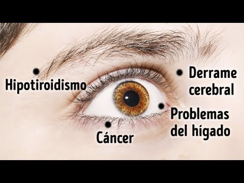 La Interconexión entre la Dilatación Pupilar Unilateral y el Dolor de Cabeza: Explorando Perspectivas Psicológicas 1 la interconexion entre la dilata