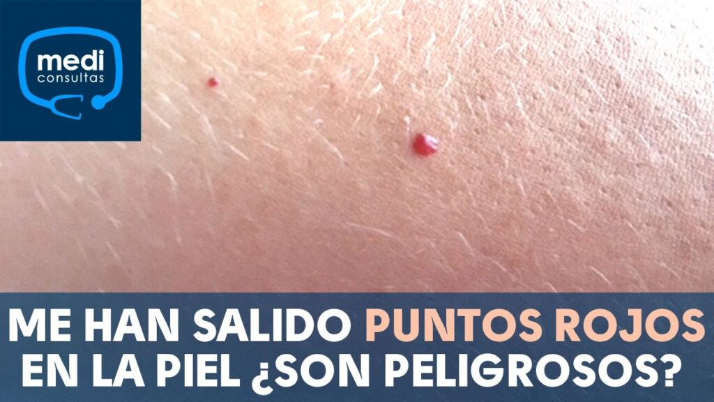Los efectos físicos de la ansiedad: explora por qué pueden aparecer petequias 1 los efectos fisicos de la ansied