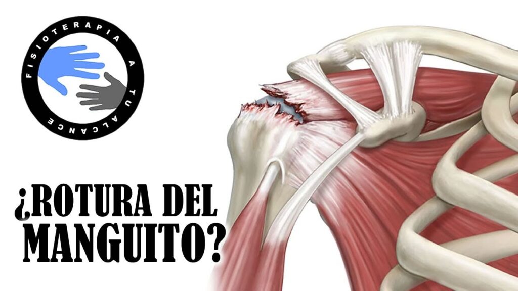 Neuralgia amiotrófica del hombro: un enfoque psicológico para comprender y manejar el dolor 1 neuralgia amiotrofica del hombro